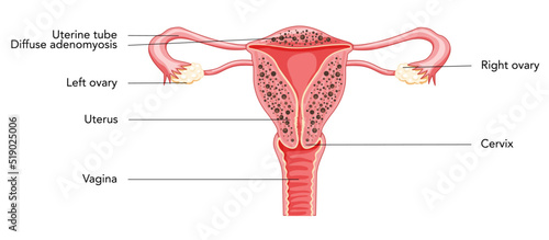 Diffuse Adenomyosis with inscriptions, Human anatomy Female reproductive Sick system organs. Structure of uterus, cervix, ovary, fallopian tube in Latin text. Frontal view in a cut Vector illustration