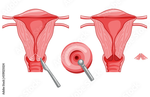 Set of Thermal coagulation of the cervix dysplasia cancer Female reproductive system Carcinoma uterus. Front view. Human anatomy internal organs location scheme, cervix, fallopian tube flat style icon