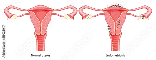 Endometriosis Female reproductive system normal and with disease pain uterus. Human anatomy internal organs location scheme flat style vector illustration Realistic flat color concept isolated white photo