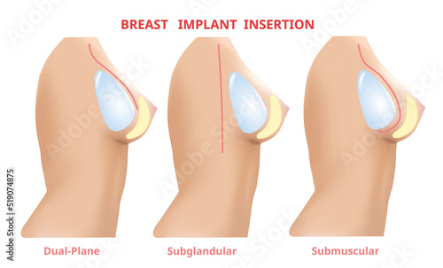 Breast implant insertion, Breast surgery silicone, 3D Realistic design Vector.