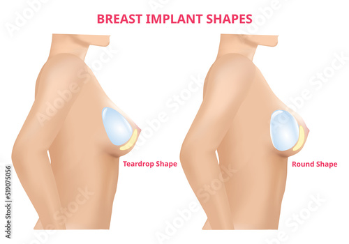Breast implant round shape and teardrop shape, Breast surgery, 3D Realistic design Vector.