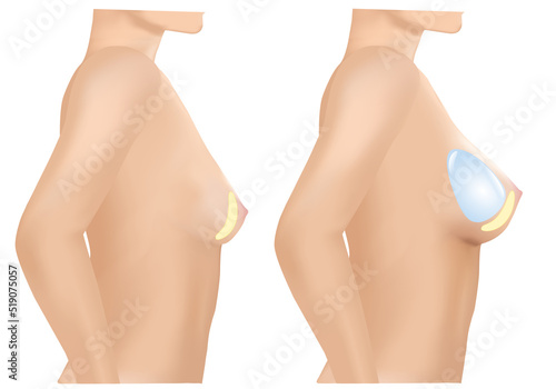 Breast implant before and after, Plastic surgery, 3D Realistic design Vector.