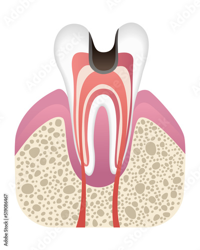 Stage of caries development. Tooth structure in flat style. Tooth decay with enamel. Dental disease realistic vector illustration