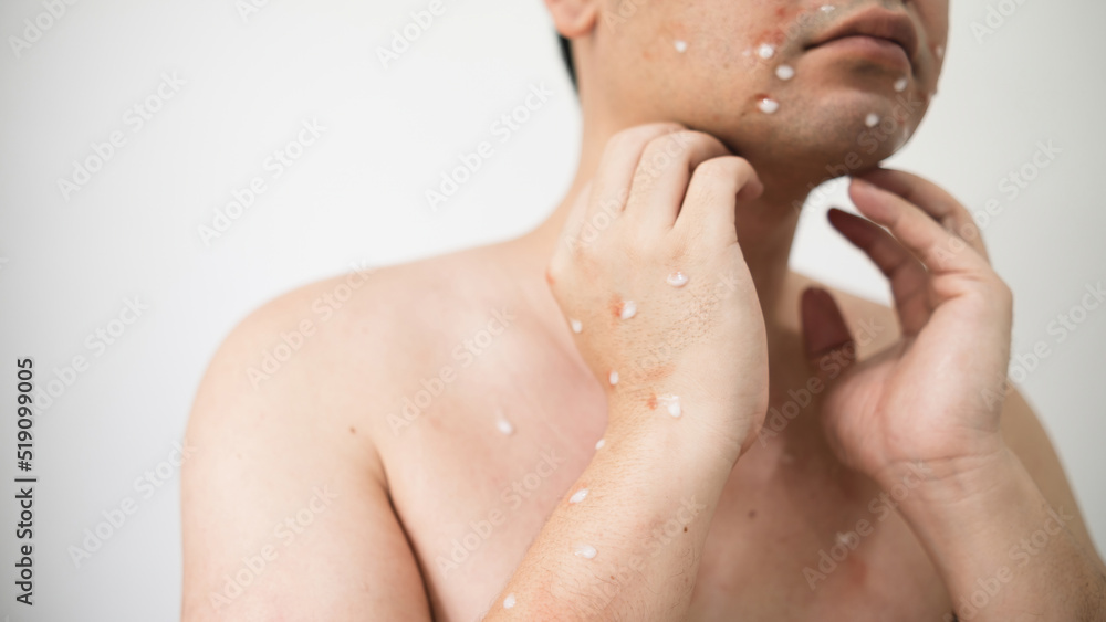 Concept of monkey pox infection, a white Asian man with pustular skin from monkeypox virus infection. Concept of monkey pox infection, a white Asian man with pustular skin from monkeypox virus infection.
