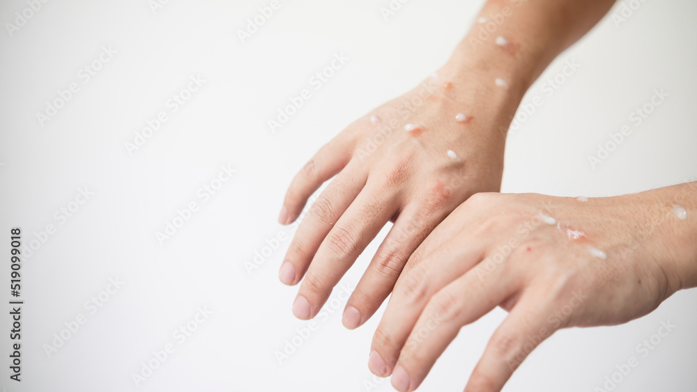 Concept of monkey pox infection, a white Asian man with pustular skin from monkeypox virus infection. Concept of monkey pox infection, a white Asian man with pustular skin from monkeypox virus infection.