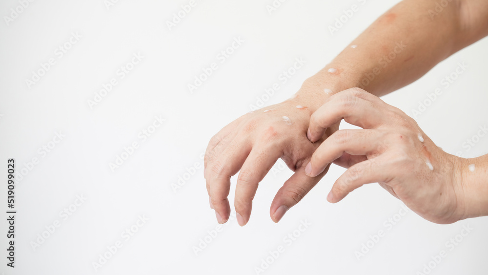 Concept of monkey pox infection, a white Asian man with pustular skin from monkeypox virus infection. Concept of monkey pox infection, a white Asian man with pustular skin from monkeypox virus infection.