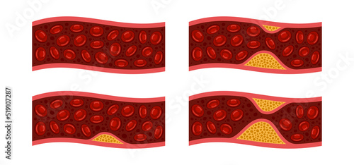 Atherosclerosis. Cholesterol in Blood Vessels Set. Vector