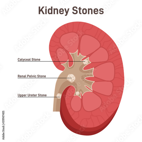 Nephrolithiasis. Kidney stones disease. Nephrology and urology