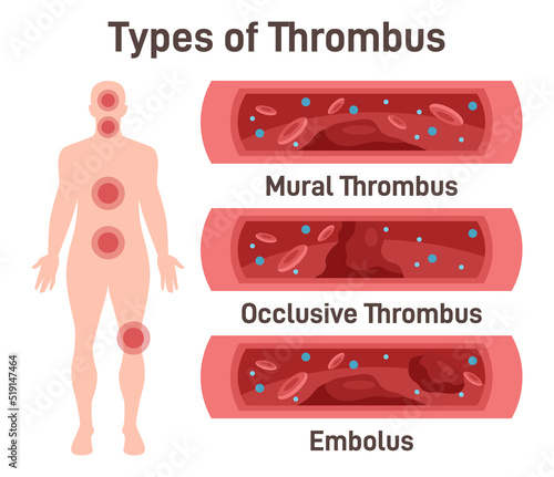 Thrombus types. Arteriosclerosis, infarct, ischemia, thrombosis disease.