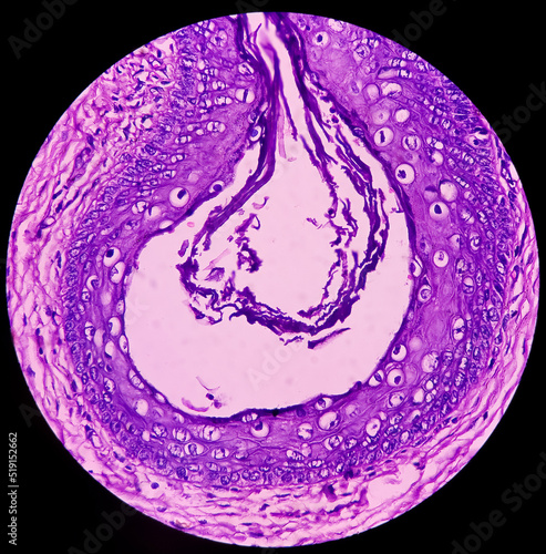 Microscopic image of neck mass cancer, Metastatic adenocarcinoma, show skin, fatty tissue, grandular component of cystic teratoma of testis. photo