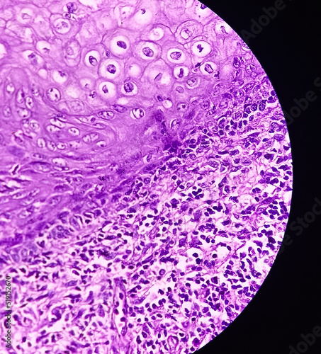 Microscopic image of neck mass cancer, Metastatic adenocarcinoma, show skin, fatty tissue, grandular component of cystic teratoma of testis. photo