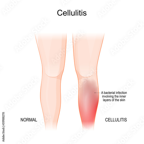 Skin cellulitis. Healthy leg, and leg with symptoms of Infectious disease. photo
