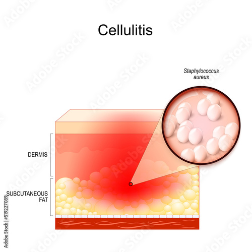 cellulitis. Cross section of layers of the human Skin with symptoms of Infectious disease. Close-up of Staphylococcus aureus. bacterial infection. Bacteria involving the inner layers of the skin.