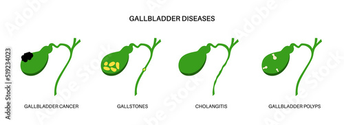 Gallbladder diseases poster