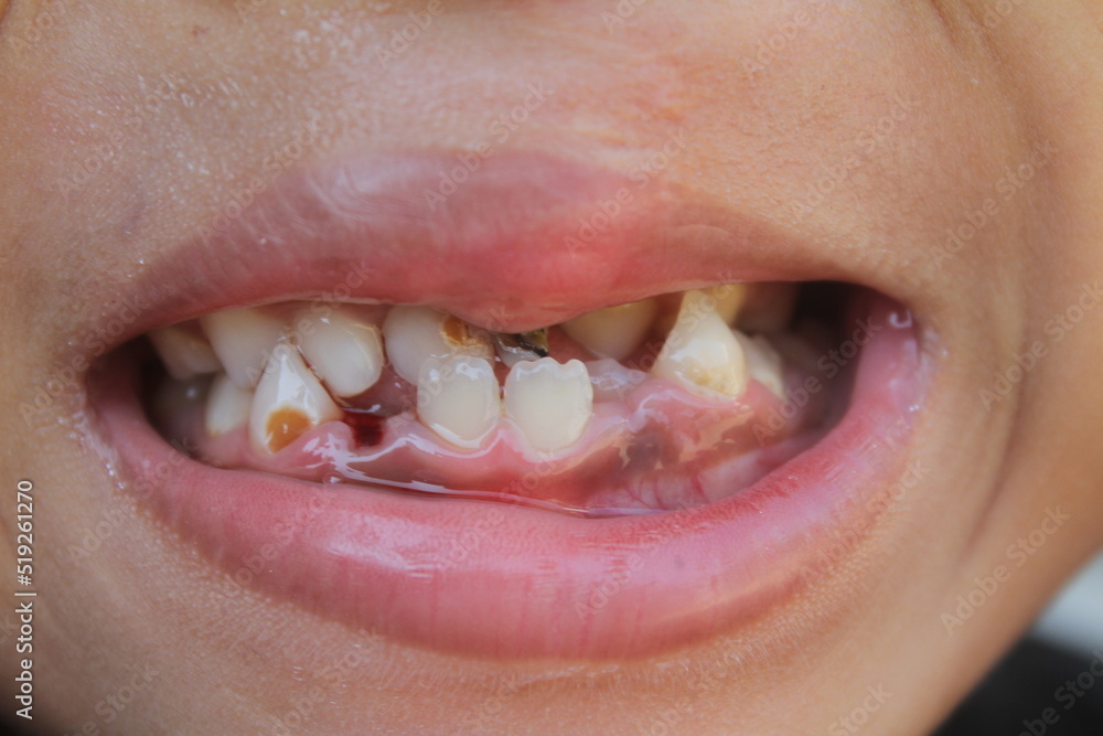 Obraz premium teeth in children cleft lip or cleft palate that is damaged, cavities and stony