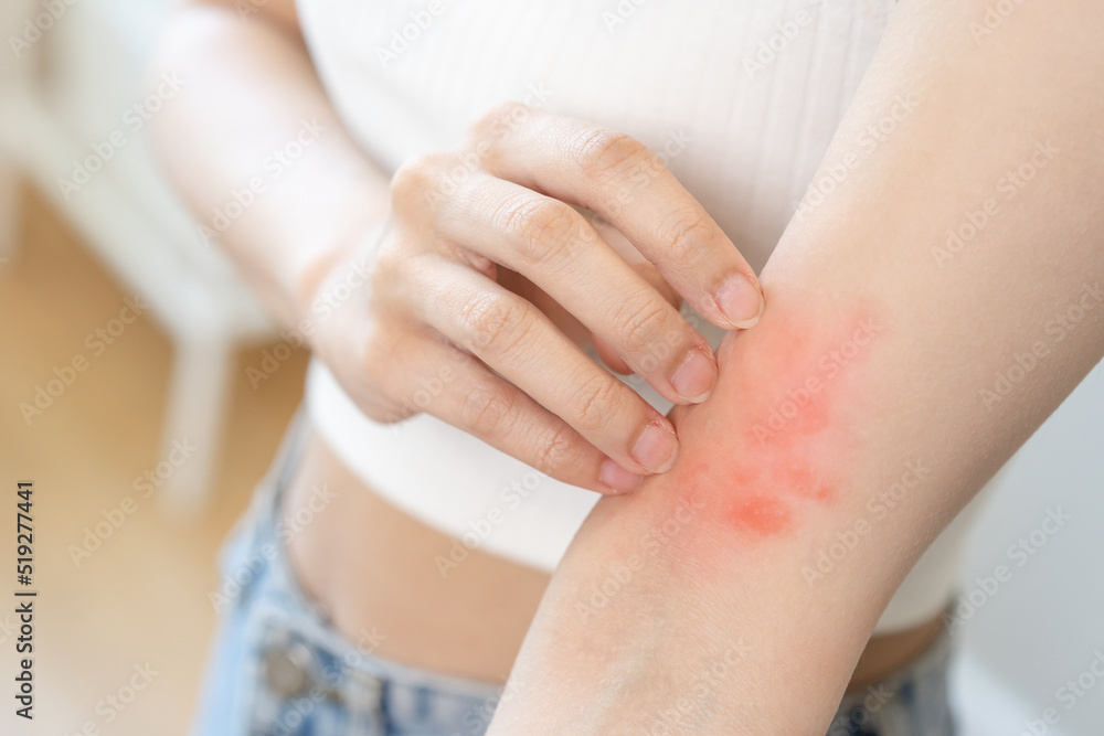 Dermatology asian young woman, girl allergy, allergic reaction from atopic, insect bites on her arm, hand in scratching itchy, itch red spot or rash of skin. Healthcare, treatment of beauty. Dermatology asian young woman, girl allergy, allergic reaction from atopic, insect bites on her arm, hand in scratching itchy, itch red spot or rash of skin. Healthcare, treatment of beauty.