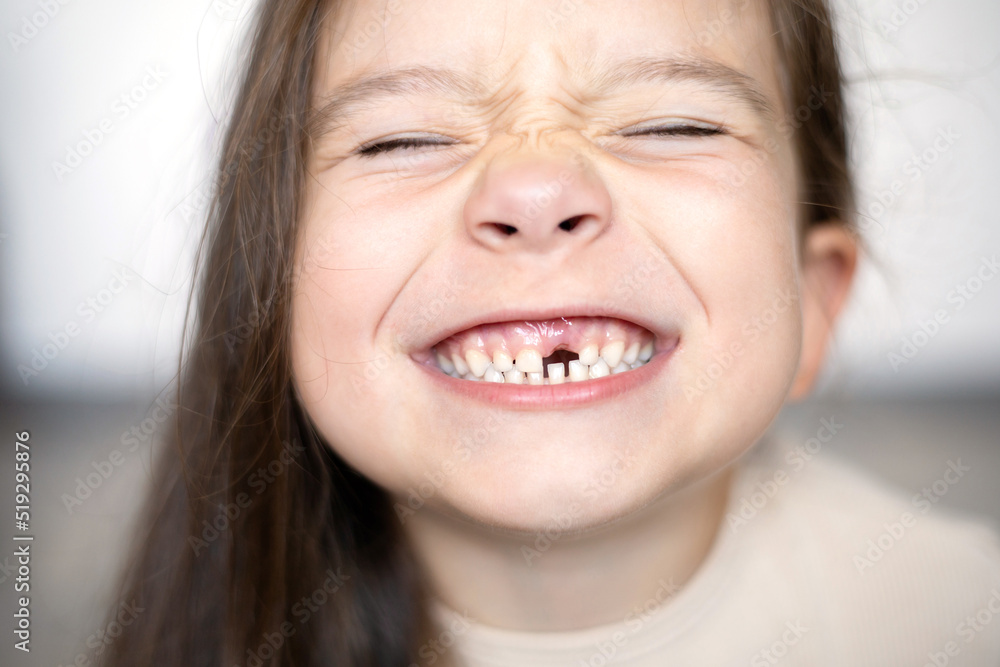 Close-up A cute funny girl without a baby tooth. A toothless smile. A milk tooth fell out. Selective focus Close-up A cute funny girl without a baby tooth. A toothless smile. A milk tooth fell out. Selective focus