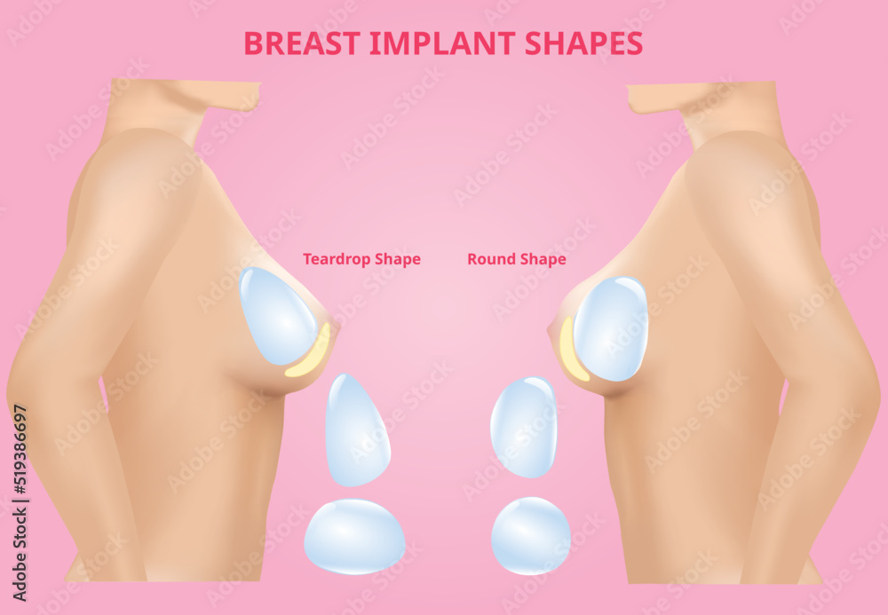 Breast Implant Types Vector & Photo (Free Trial)