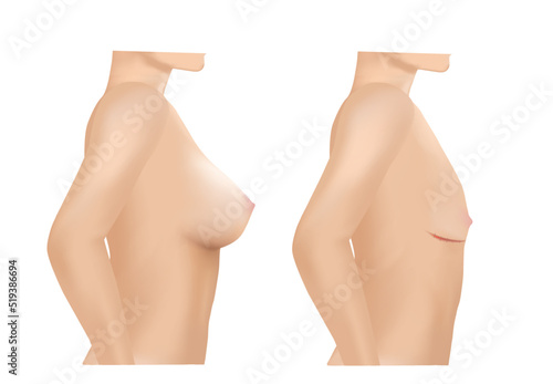 Breast cancer surgery scars, lumpectomy, Breast cancer removal