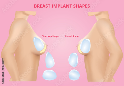 Silicone Breast Implants, compare round and tear drop, Realistic design vector.