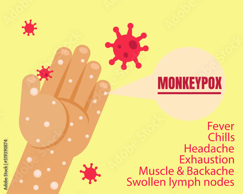 Monkeypox outbreak concept. Hands with virus. Cartoon vector style for your design.