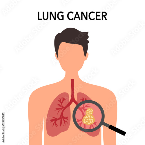 Lung cancer disease concept vector illustration on white background.