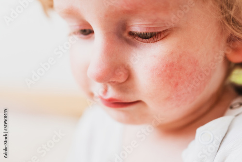food allergy in a young child on the cheeks