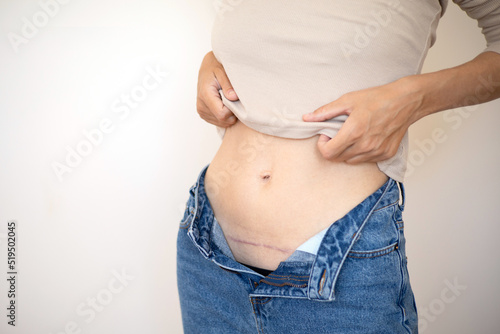 Close up Mom's abdomen after cesarean section. Scar seam. bodypositive diversity Real motherhood. Lifestyle © Анна Брусницына