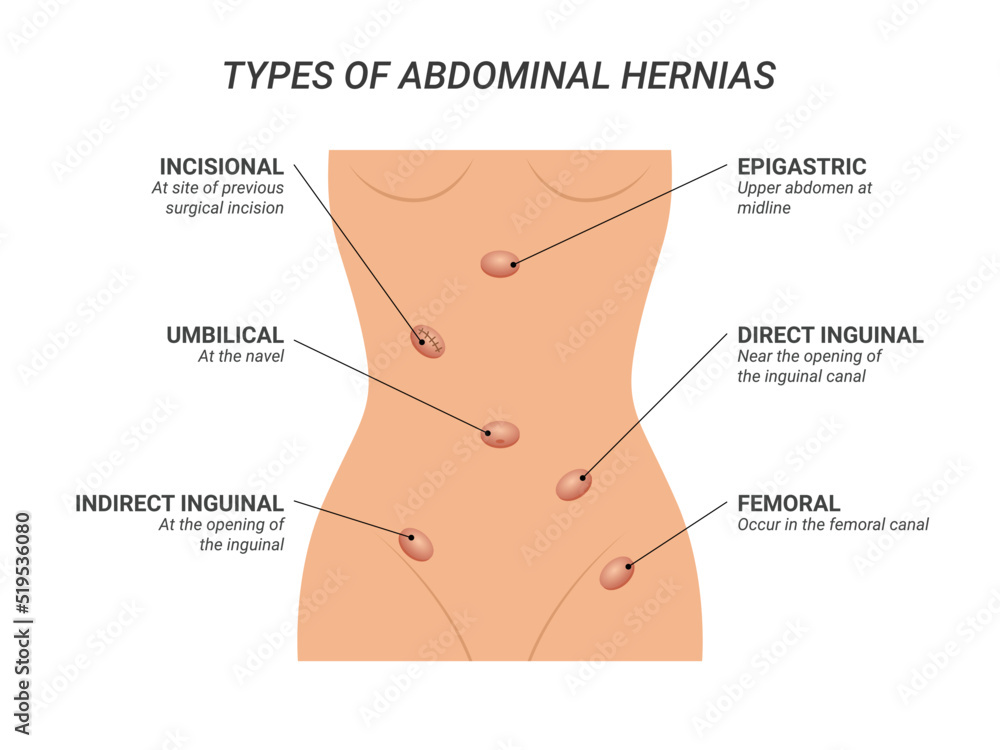 Types of abdominal hernias illustration on isolated background - obrazy, fototapety, plakaty 