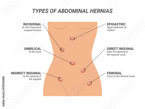 Types of abdominal hernias illustration on isolated background
