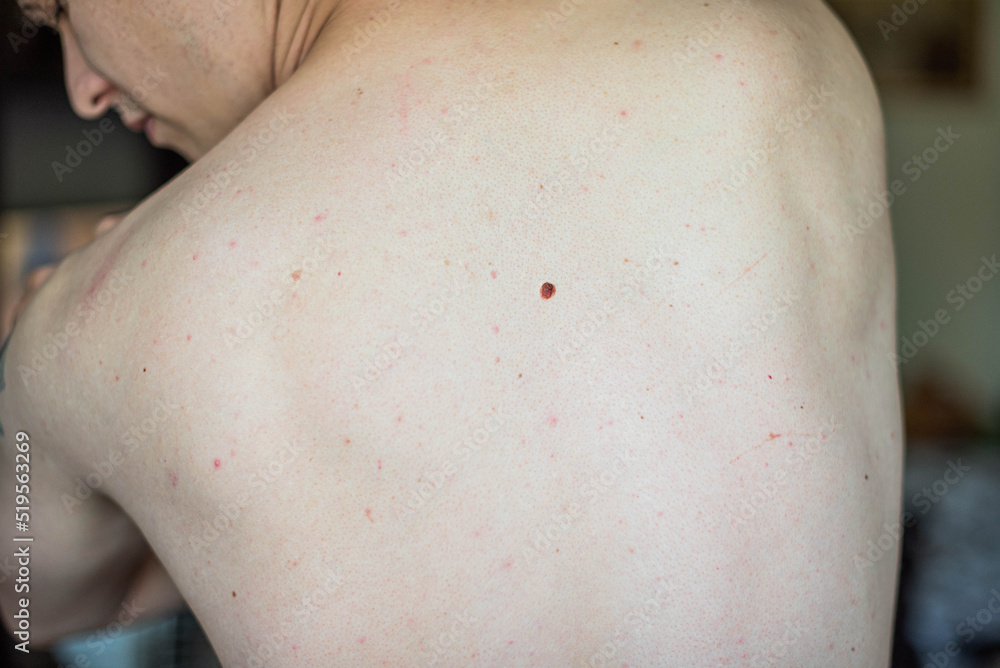 Checking benign moles. Close up detail of the bare skin on a man back with scattered moles and freckles. Sun effect on skin. Pigmentation. Birthmarks on skin Checking benign moles. Close up detail of the bare skin on a man back with scattered moles and freckles. Sun effect on skin. Pigmentation. Birthmarks on skin