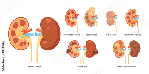 Healthy kidneys and different diseases vector illustrations set. CKD, kidneys tumor, renal artery stenosis, cancer, cyst, stones isolated on white background. Health, anatomy, medicine concept