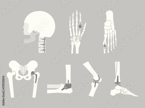 Joint implants in human skeleton cartoon illustration set. Different finger, knee, leg, ankle replacement prothesis. Arthritis, rheumatoid, healthcare, surgery, anatomy, disease concept