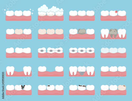 Healthy and decayed teeth cartoon illustration set. Childrens teeth with braces, cracks, spots, broken roots and dental veneers. Dentistry, health, anatomy, healthcare concept