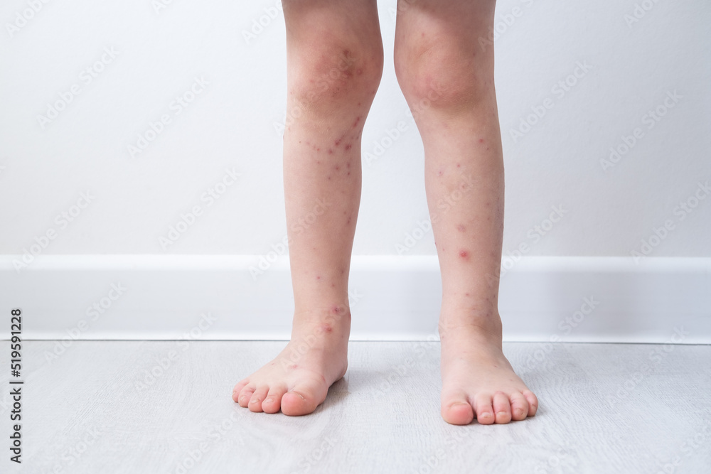 Chickenpox disease, close up little boy legs with red rashes Chicken