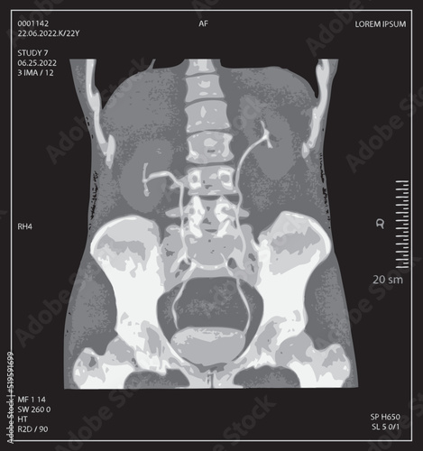 vector x-ray of human abdomen with pelvic bone and spine. Medical diagnostics of the digestive system and kidneys