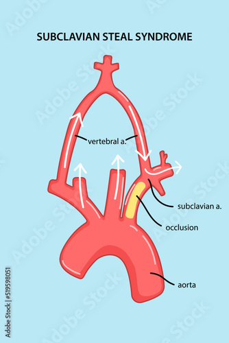 Subclavian steal syndrome. Medical vector illustration.