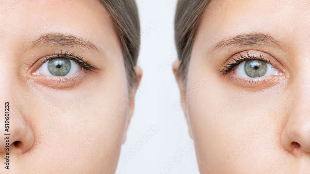 Close up of a young caucasian woman's face with drooping upper eyelid before and after blepharoplasty isolated on white background. Result of plastic surgery. Changing the shape, cut of the eyes - obrazy, fototapety, plakaty 