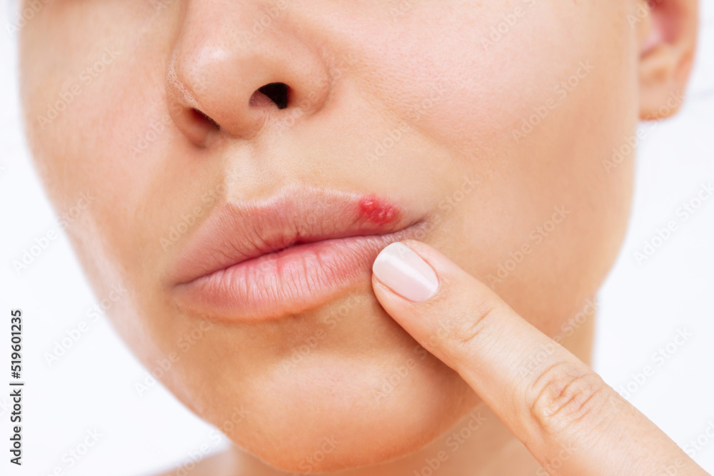 Herpes on the lip. Young woman points at blisters caused by virus on