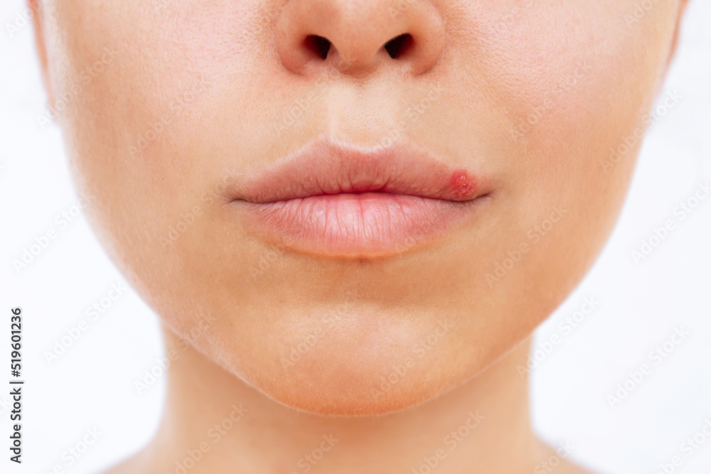 Herpes on the lip. Blisters caused by virus on the mouth of a young woman isolated on a white background. Itching and redness on the girl's face