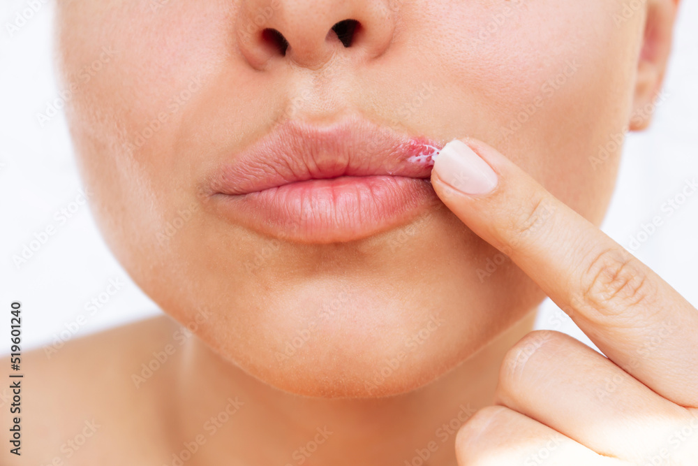 Herpes on the lip. Young woman smears the blisters caused by virus on the mouth with ointment isolated on a white background. Itching and redness on the girl's face. Treatment of herpes - obrazy, fototapety, plakaty 