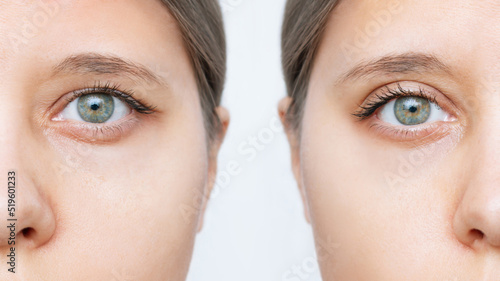 Close up of a young caucasian woman's face with drooping upper eyelid before and after blepharoplasty isolated on white background. Result of plastic surgery. Changing the shape, cut of the eyes