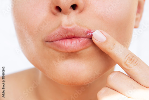 Herpes on the lip. Young woman smears the blisters caused by virus on the mouth with ointment isolated on a white background. Itching and redness on the girl's face. Treatment of herpes photo