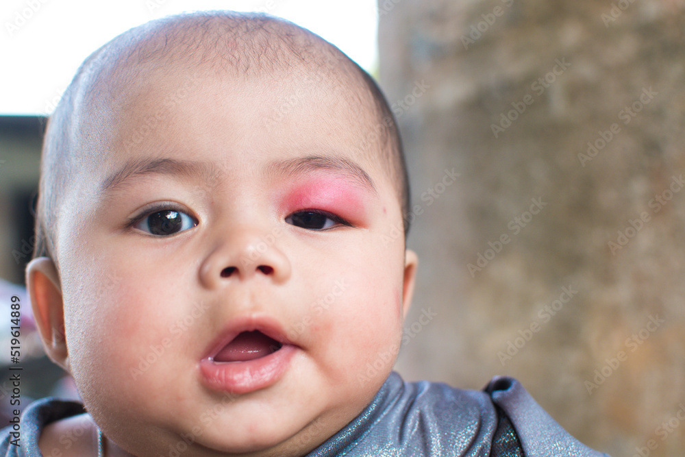 little baby infection at the eyelid caused by being bitten by insects causing swelling and redness and heat and itching little baby infection at the eyelid caused by being bitten by insects causing swelling and redness and heat and itching