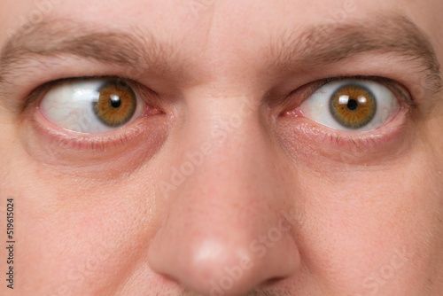 A man with strabismus squints his eyes on a white background. photo