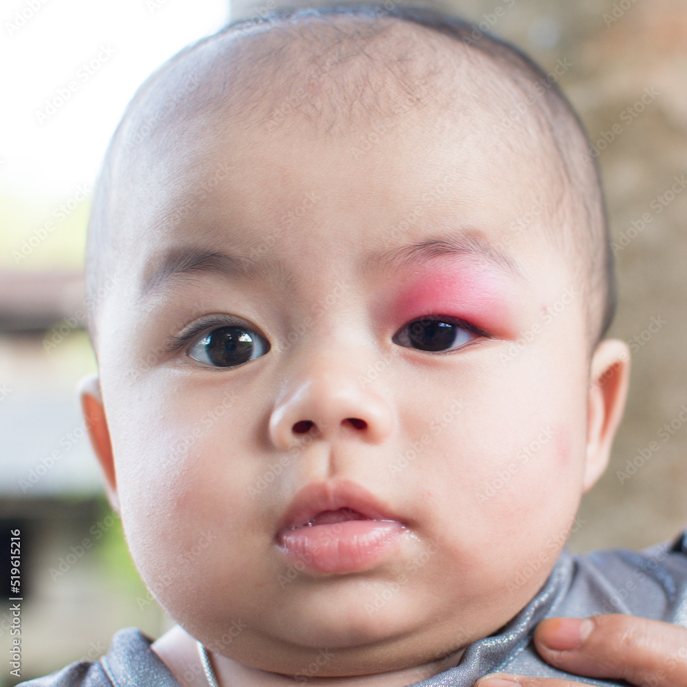 little baby infection at the eyelid caused by being bitten by insects causing swelling and redness and heat and itching little baby infection at the eyelid caused by being bitten by insects causing swelling and redness and heat and itching