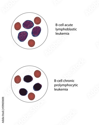 vector illustration of cells of leukemia