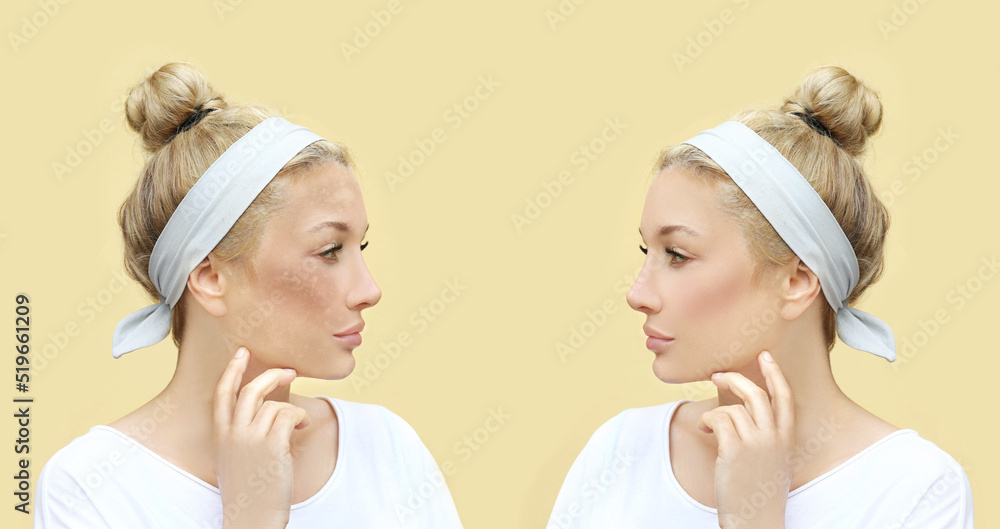 Hyperpigmentation: chloasma, melasma , age spots,Post-inflammatory hyperpigmentation.Hyperpigmentation removal Hyperpigmentation: chloasma, melasma , age spots,Post-inflammatory hyperpigmentation.Hyperpigmentation removal