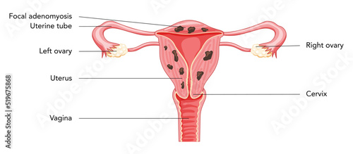 Adenomyosis Focal with inscriptions, Human anatomy Female reproductive Sick system organs. Structure of uterus, cervix, ovary, fallopian tube in Latin text. Frontal view in a cut Vector illustration