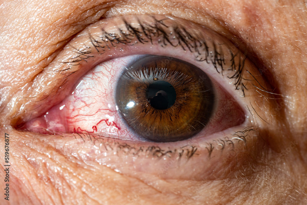 Close-up of female eye with red inflamed and dilated capillaries. Blood vessel. Close-up of female eye with red inflamed and dilated capillaries. Blood vessel.